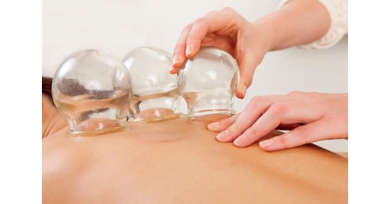 Unlocking Wellness: The Benefits of TCM Cupping Therapy in Singapore